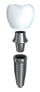 Dental Implant