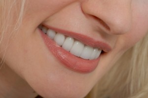 Veneers in Van Nuys CA