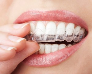 Braces in Los Feliz CA