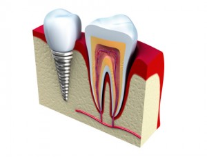 Dental implants