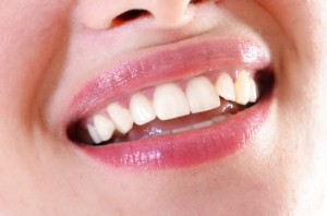 veneers