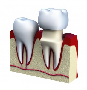 Same Day Crowns