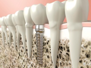 Is There Such a Thing as Metal-Free Dental Implants?