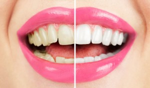 Options for Cleaning Stained Teeth