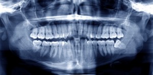 Top 4 Wisdom Tooth Problems