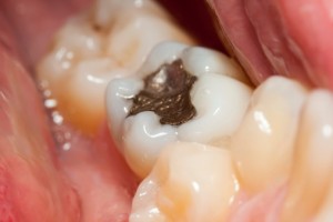 The EPA is Concerned About Dental Mercury--Should You Be Too?