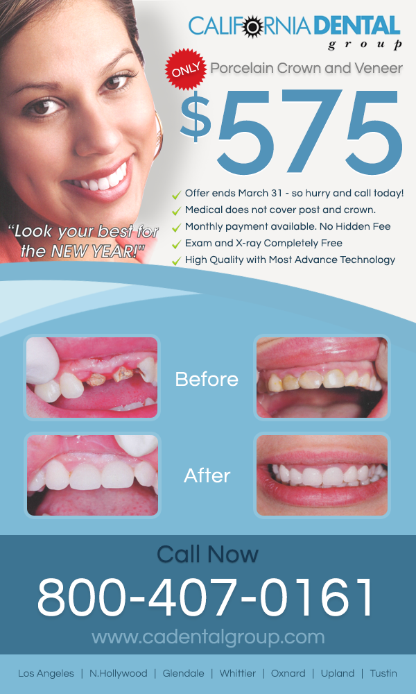 veneers near me payment plan