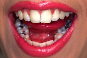 Comparing Composite Fillings and Metal Fillings