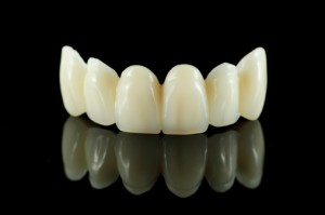 dental bridge