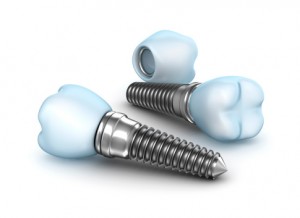 dental implant