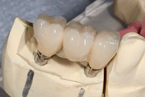 What to Expect When Getting Dental Implants