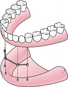 All About All-on-4 Dental Implants