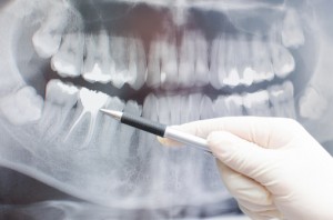 Composite Restorations: Repair vs Replacement