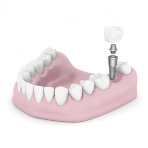 4 Things You Need to Know About Dental Implants