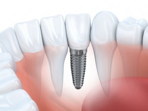 Could Stem Cell Technology Replace Dental Implants?