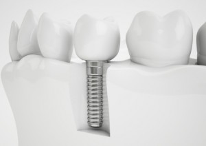 Are Dental Implants in Your Future? Start Planning Now to Pay for Them