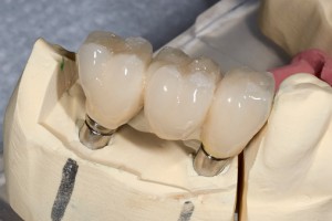 The Dirty Truth About Dental Bridges