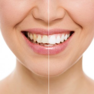 What You Need to Know About Teeth Whitening and the FDA