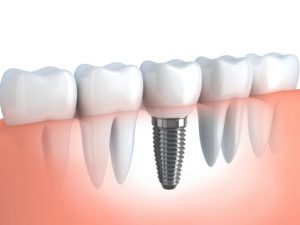 Tips for Successful Dental Implants