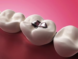 Everything You Need to Know About Amalgam Fillings 