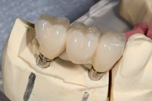 Everything You Need to Know About California Dental Implants