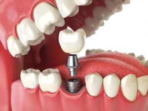 How to Select the Best California Dentist for Your Dental Implant Procedure 