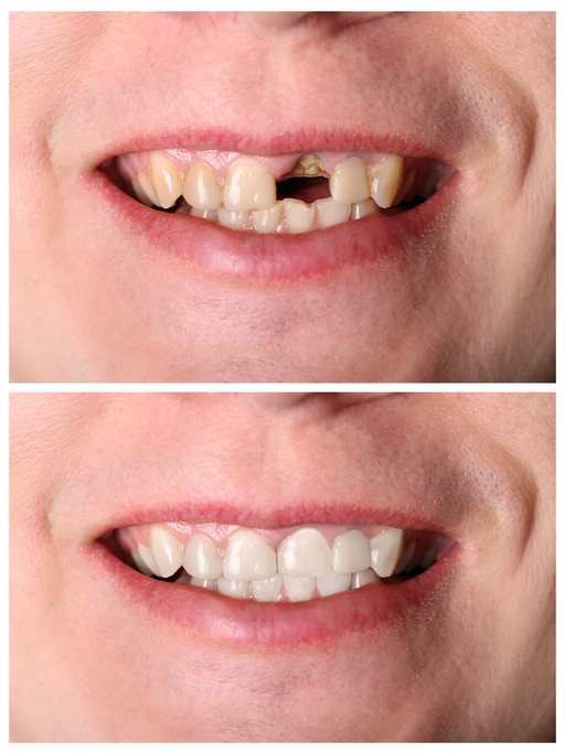Incisive tooth restoration before and after treatment
