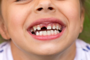 Do You Know What to Do if Your Child Has a Tooth Knocked Out?