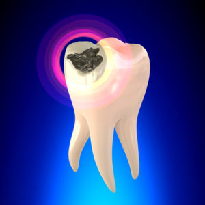 What Exactly is a Cavity and How Can I Prevent Them?