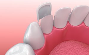 Get Answers to Your Commonly Asked Questions About Porcelain Veneers