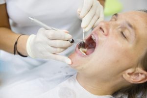Get Answers to 5 of the Most Commonly Asked Questions About Root Canals