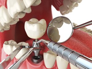 What to Expect if You Choose Dental Implants: Services You’ll Get
