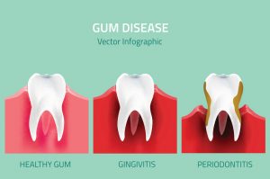 Gingivitis vs Periodontitis: What’s the Difference?