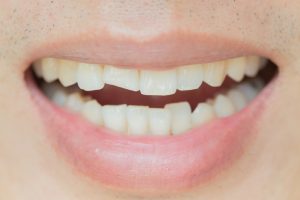 Do You Have a Cracked Tooth? Important Signs You May Be Overlooking