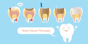 Root Canals and Pain: Is It as Bad as You’re Imagining?
