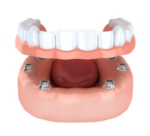 Check Out These 4 Ways that Dental Implants May Be Better for You Than Dentures