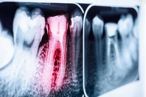 Do You Have a Cavity? These 4 Warning Signs May Point to Yes