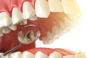 5 Signs That You May Have a Cavity