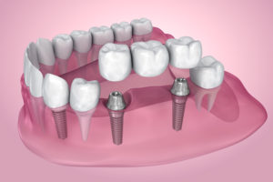 The Recovery Time for Dental Implants is Likely Shorter Than You Think