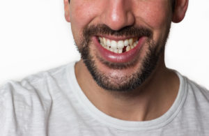 The Truth About a Missing Tooth: Learn Why It Shouldn’t Be Ignored