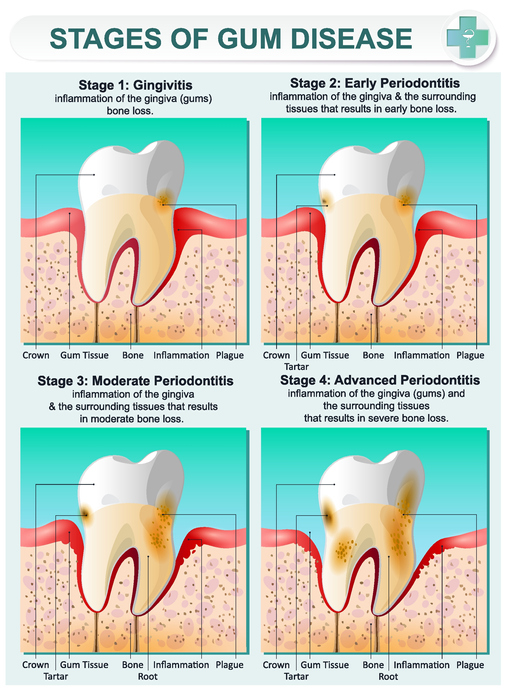 Answers to the Three Most Commonly Asked Questions About Gingivitis