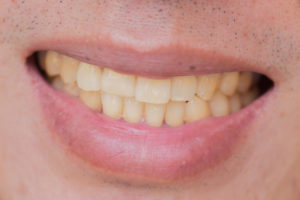 Have You Noticed Your Teeth Have Been Stained? These are 8 Potential Reasons 