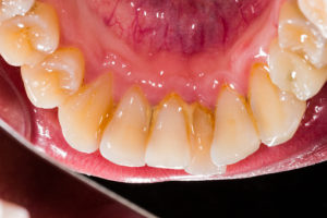 Dental Plaque Buildup