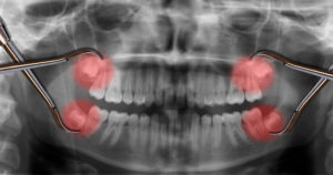 What are wisdom teeth?