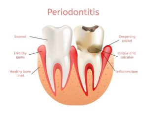 What is periodontal disease and how it is treated