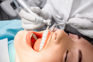 What you should know about tooth polishing