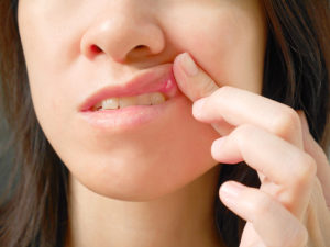 Canker sores and your oral health questions and answers