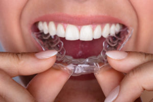Invisalign is a simple and intuitive procedure