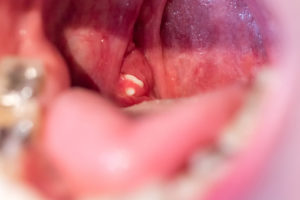 What are tonsil stones and should you be concerned?