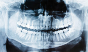 Panoramic X-rays, a comprehensive view of your teeth and jaws